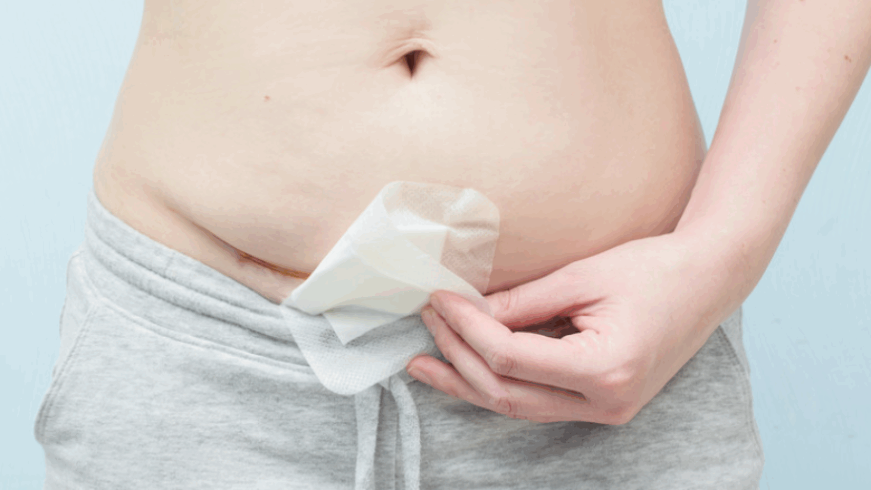 Ανάρρωση μετά από Καισαρική