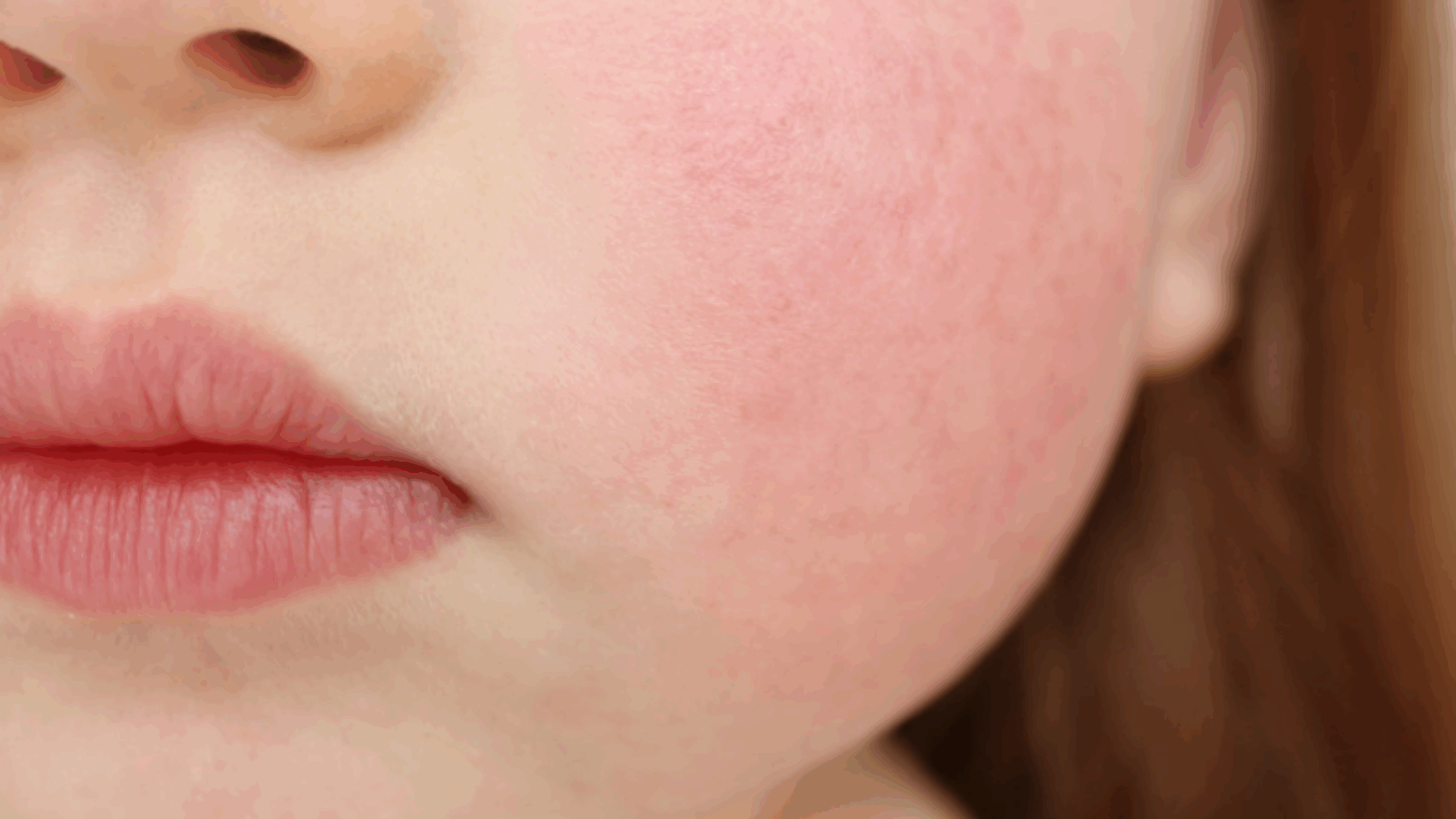 Κόκκινα Μάγουλα Στα Παιδιά